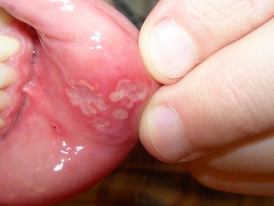 Canker sore in vagina - Answers.com